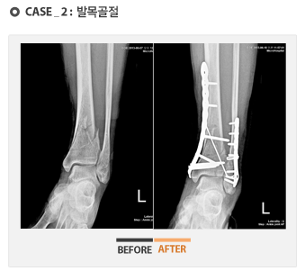 case1 - 발목골절 수술 전후 사진