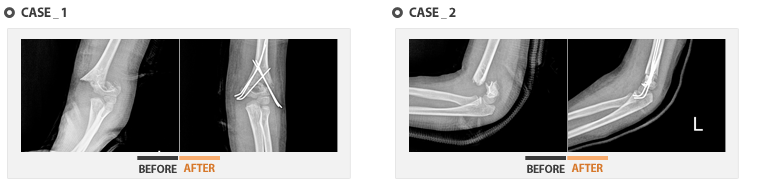 case_1 상지골의 X-ray 전후사진 / case_2 상지골의 X-ray 전후사진